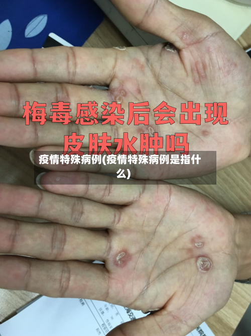 疫情特殊病例(疫情特殊病例是指什么)